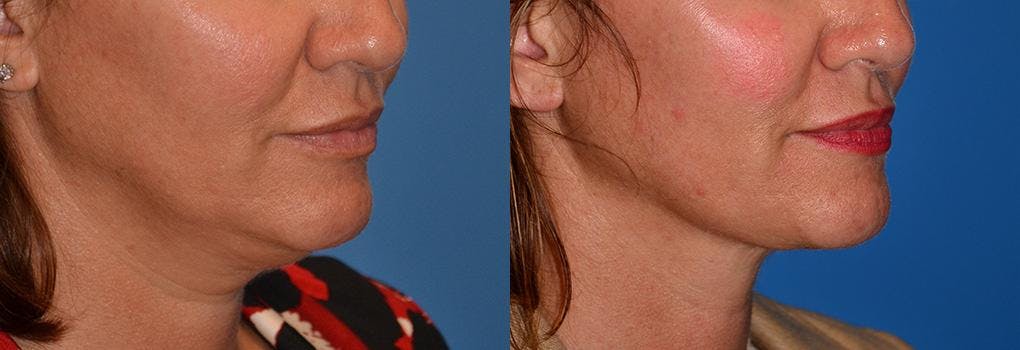 Laser Assisted Weekend Neck Lift Before & After Gallery - Patient 122406465 - Image 4