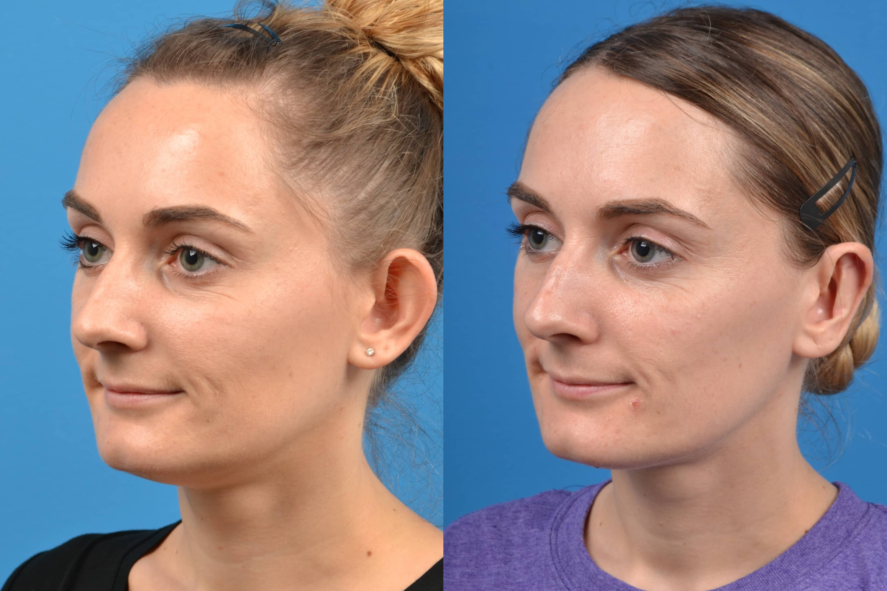 Ear Surgery Before & After Gallery - Patient 122406468 - Image 4