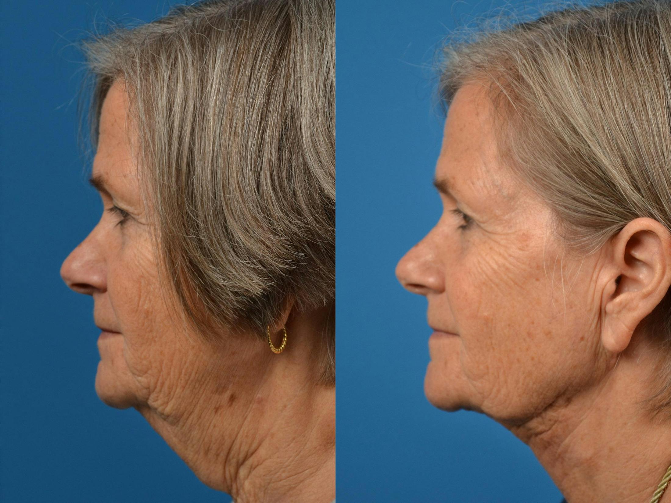 Profile Neck Lift Before & After Gallery - Patient 122406467 - Image 5