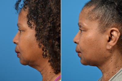 Laser Assisted Weekend Neck Lift Before & After Gallery - Patient 122406466 - Image 1
