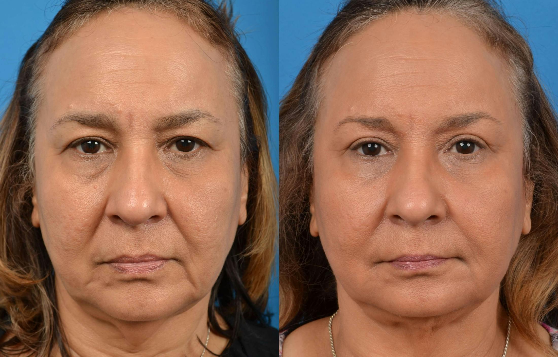 Laser Assisted Weekend Neck Lift Before & After Gallery - Patient 122406473 - Image 1