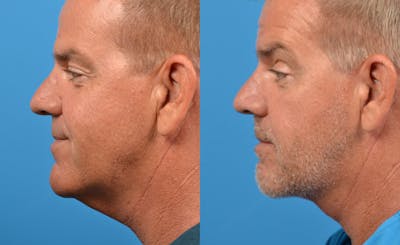 Profile Neck Lift Before & After Gallery - Patient 122406479 - Image 1
