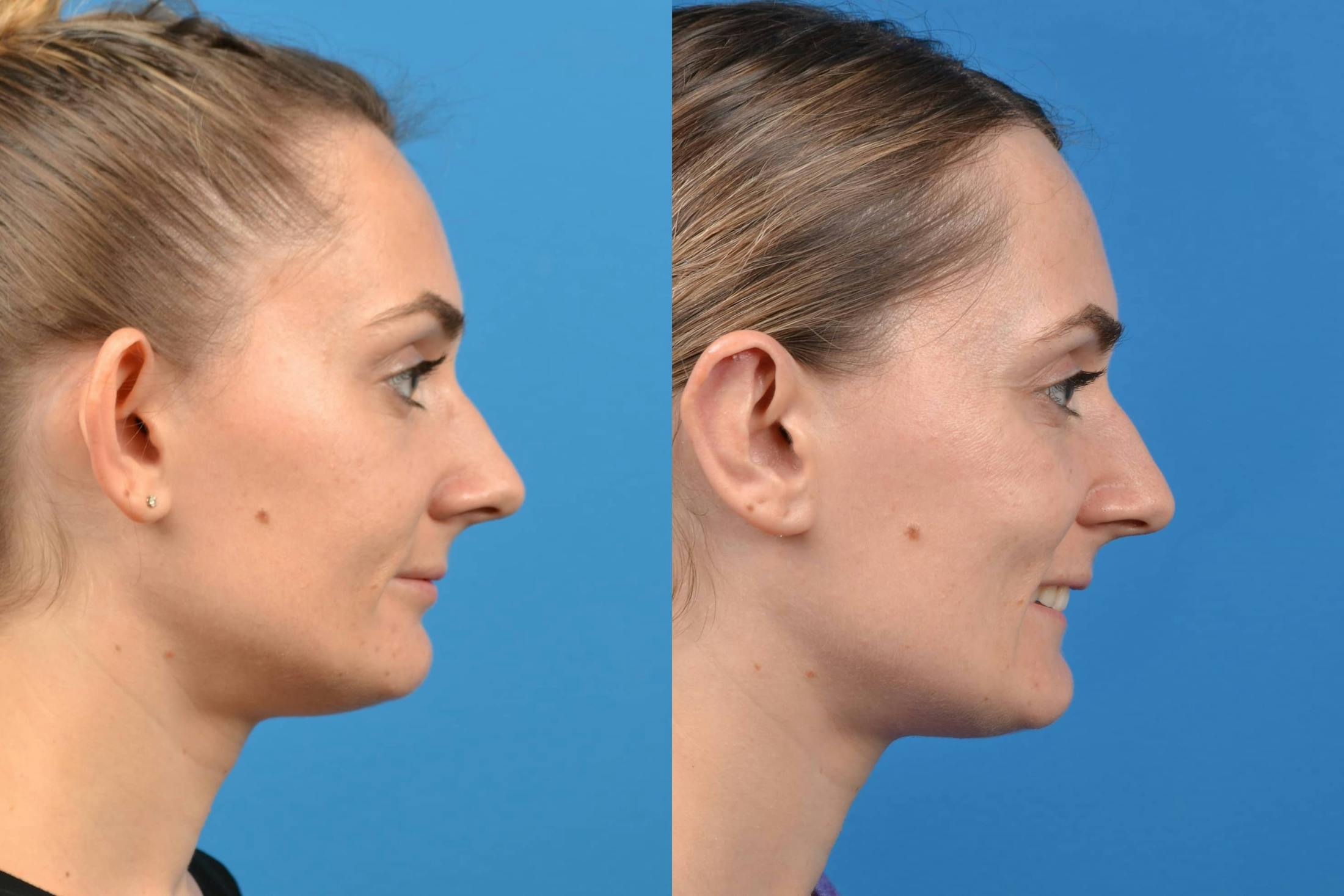 Ear Surgery Before & After Gallery - Patient 122406468 - Image 6