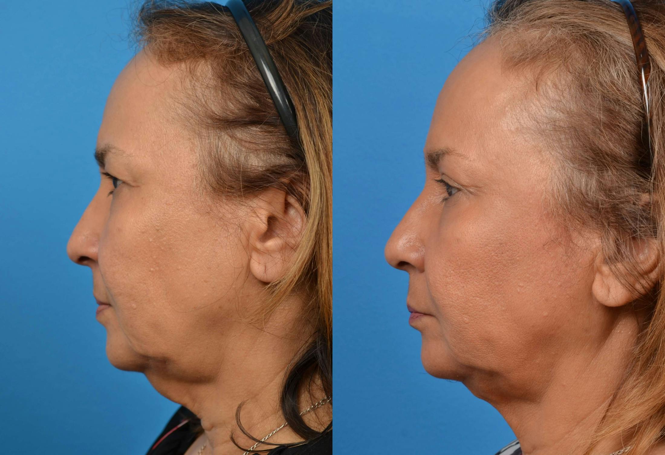Laser Assisted Weekend Neck Lift Before & After Gallery - Patient 122406473 - Image 2