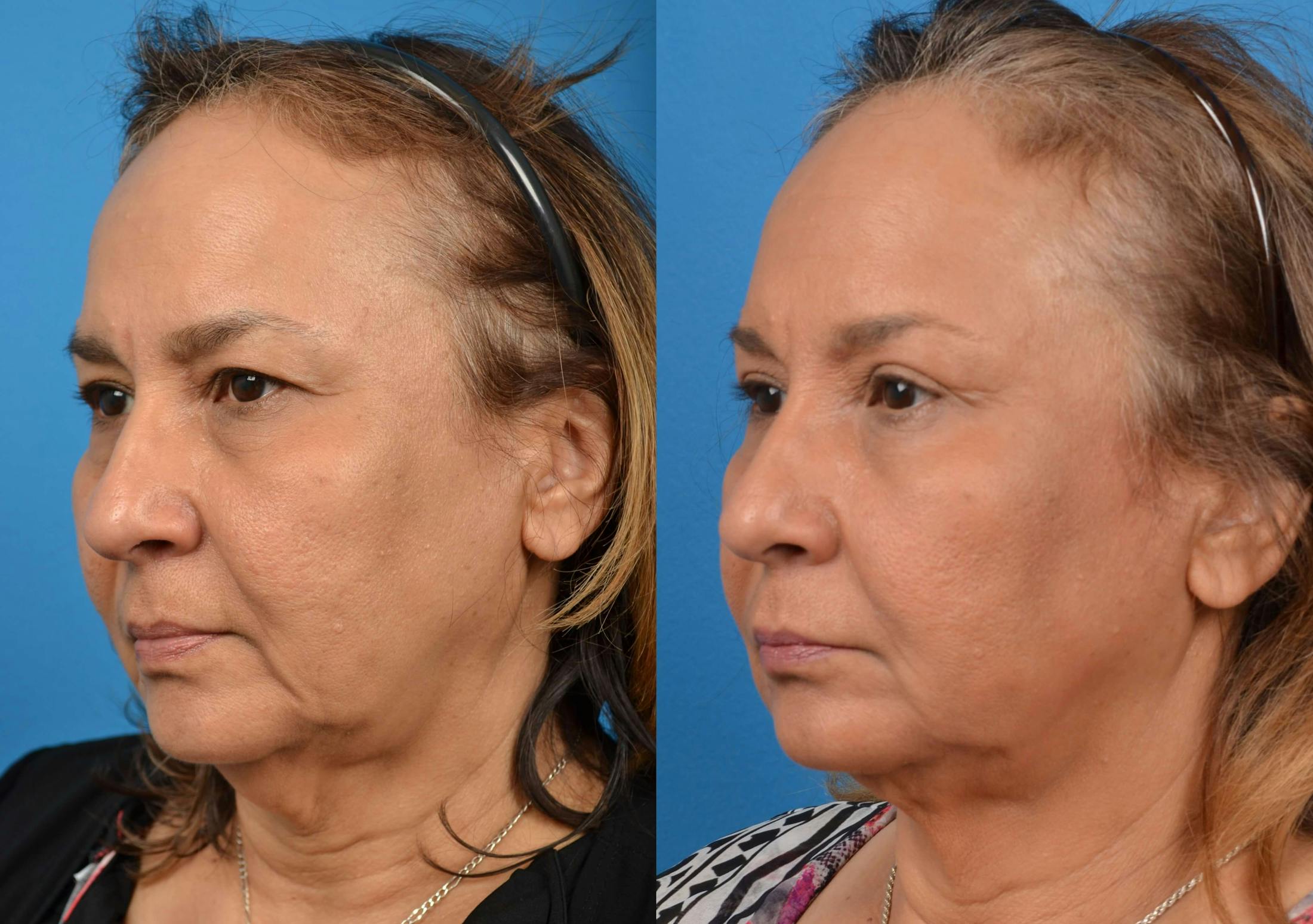 Laser Assisted Weekend Neck Lift Before & After Gallery - Patient 122406473 - Image 3