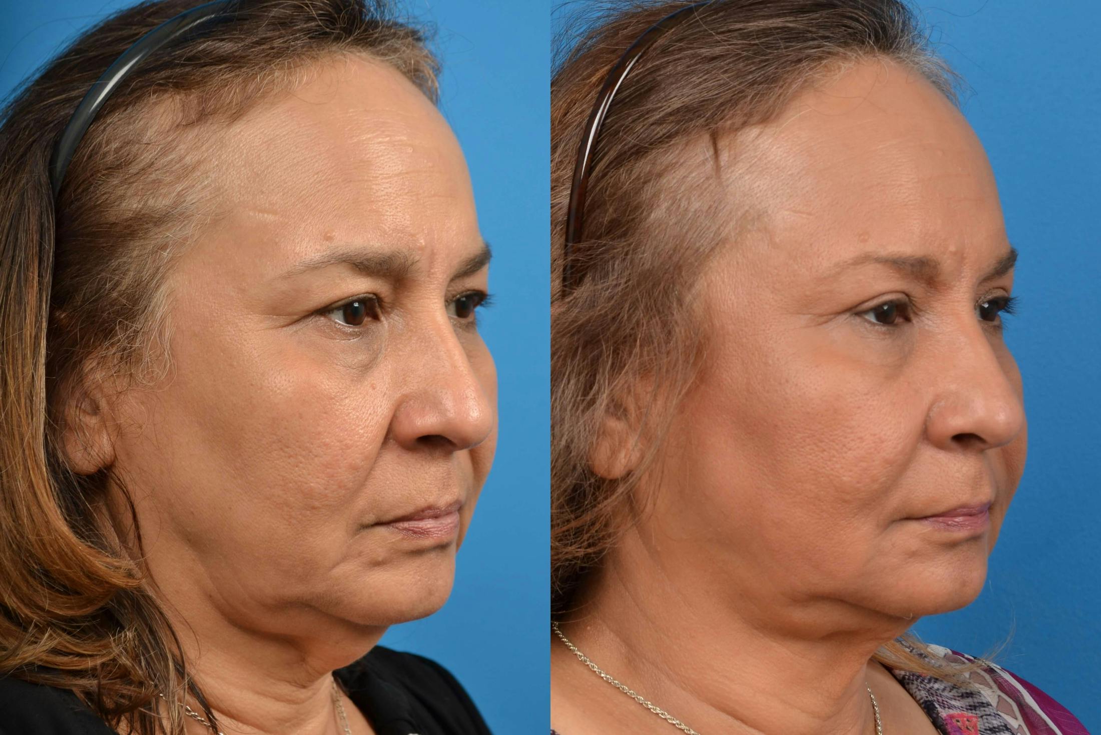 Laser Assisted Weekend Neck Lift Before & After Gallery - Patient 122406473 - Image 4