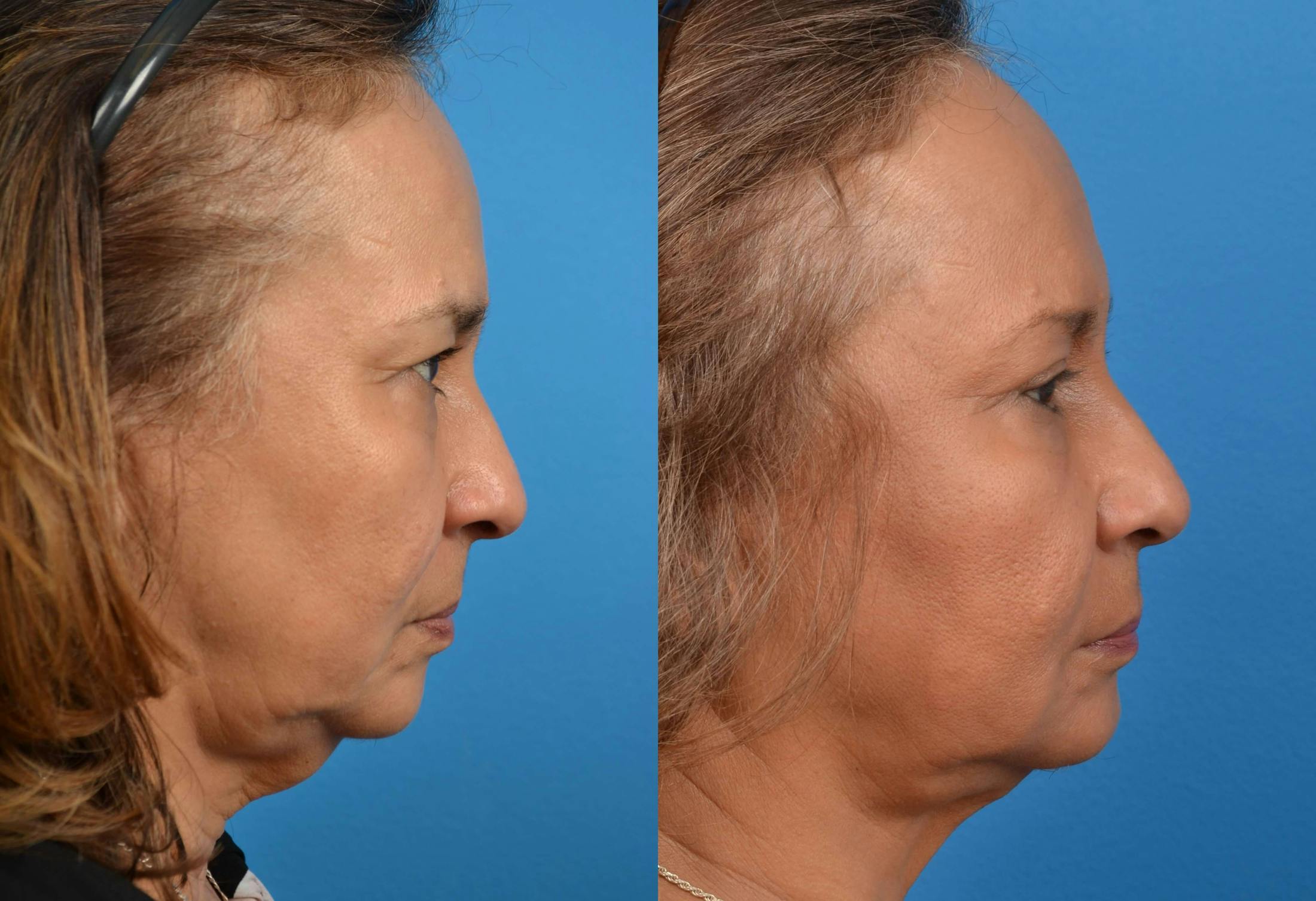Laser Assisted Weekend Neck Lift Before & After Gallery - Patient 122406473 - Image 5