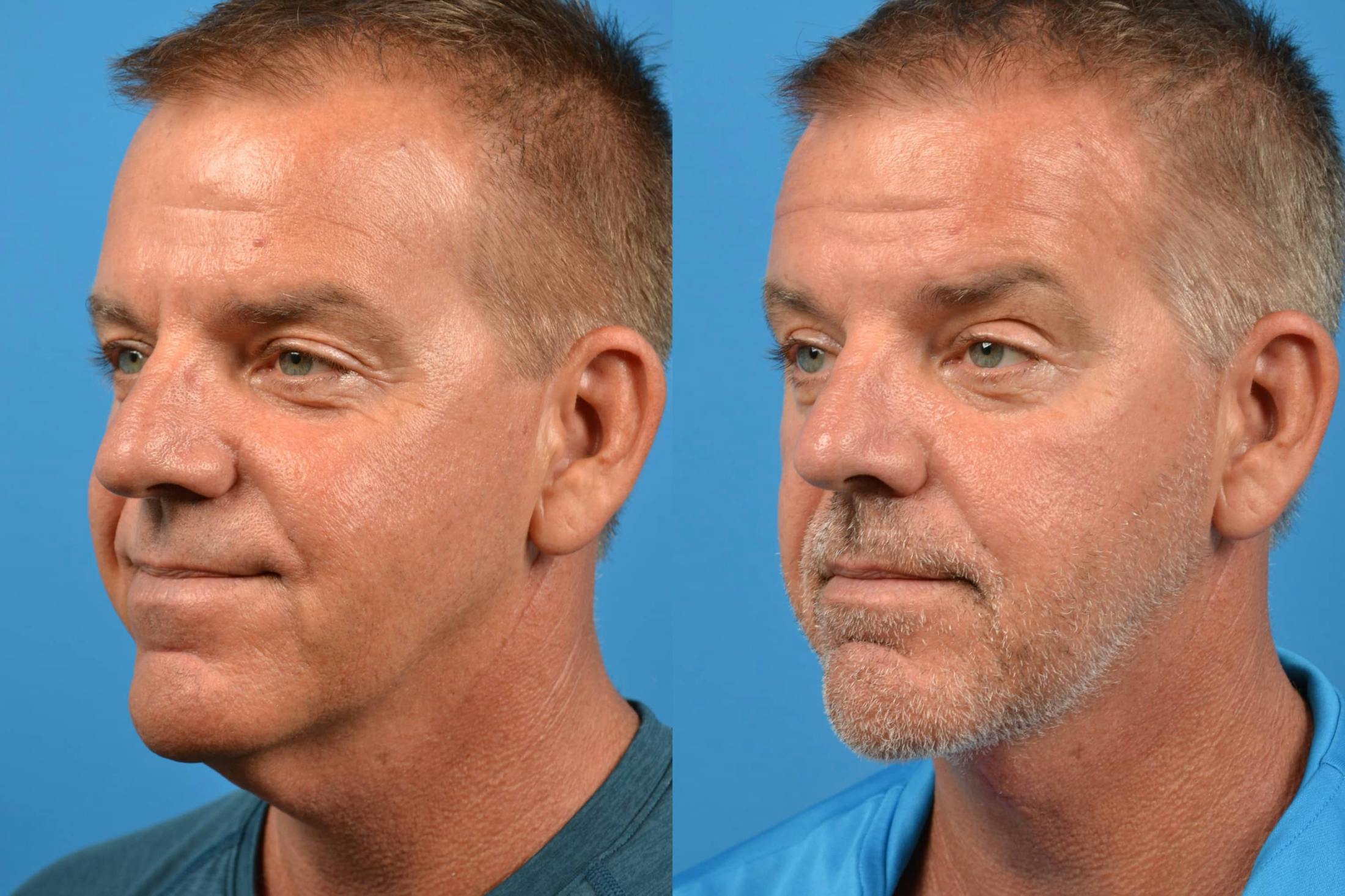 Profile Neck Lift Before & After Gallery - Patient 122406479 - Image 2