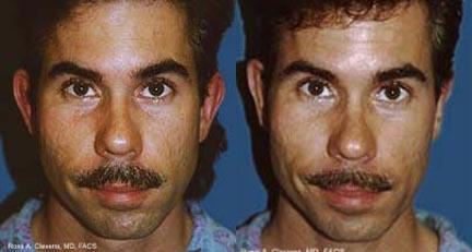 Ear Surgery Before & After Gallery - Patient 122406474 - Image 1