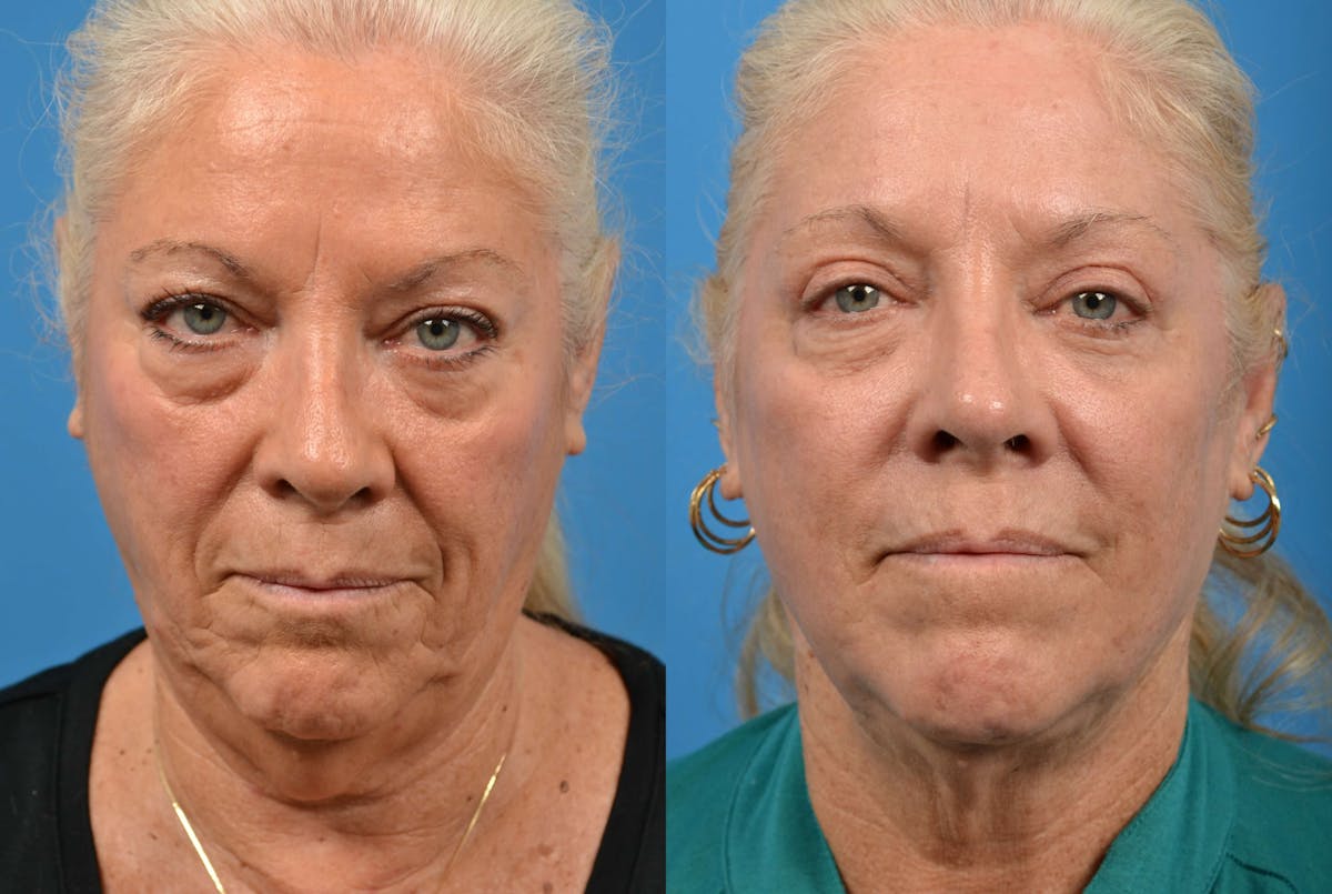 Laser Assisted Weekend Neck Lift Before & After Gallery - Patient 122406477 - Image 1