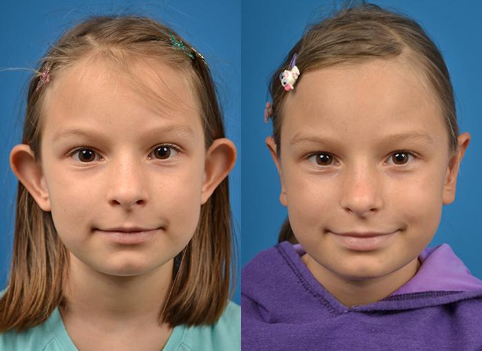 Ear Surgery Before & After Gallery - Patient 122406475 - Image 1