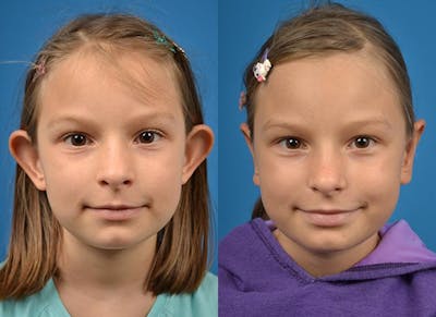 Ear Surgery Before & After Gallery - Patient 122406475 - Image 1