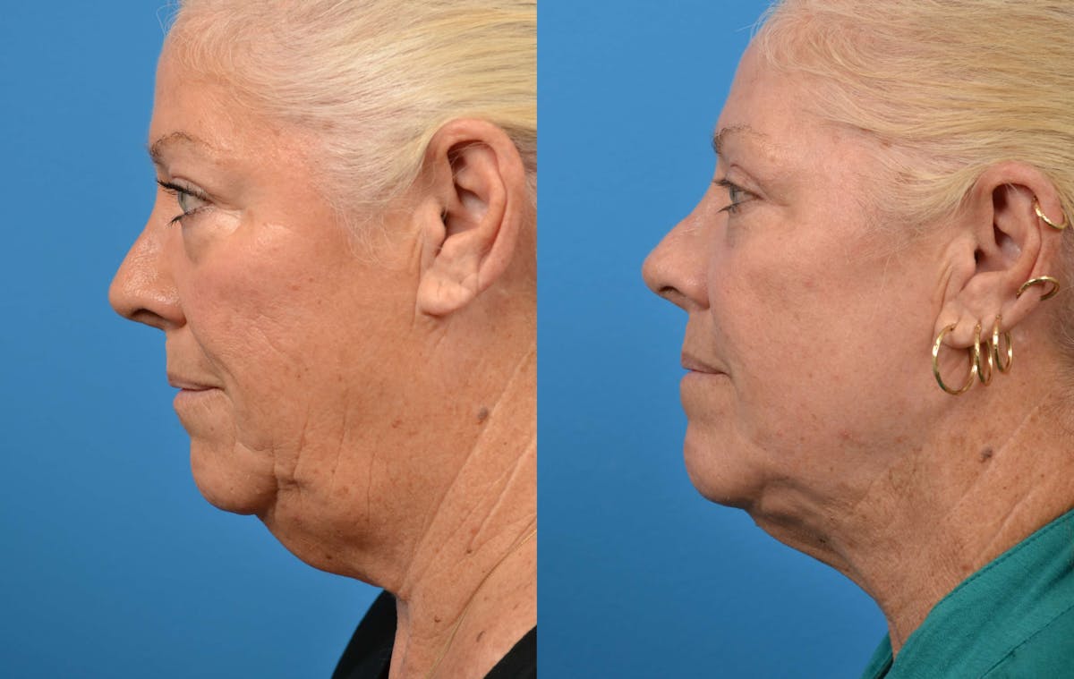Laser Assisted Weekend Neck Lift Before & After Gallery - Patient 122406477 - Image 2
