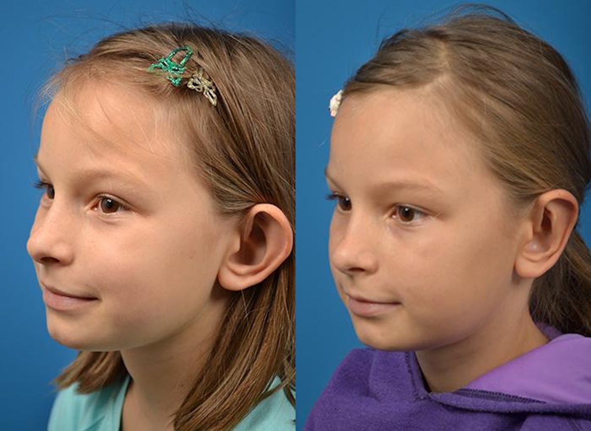 Ear Surgery Before & After Gallery - Patient 122406475 - Image 2