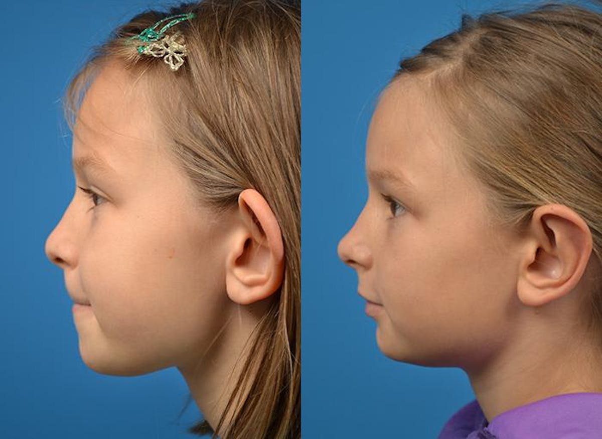 Ear Surgery Before & After Gallery - Patient 122406475 - Image 3