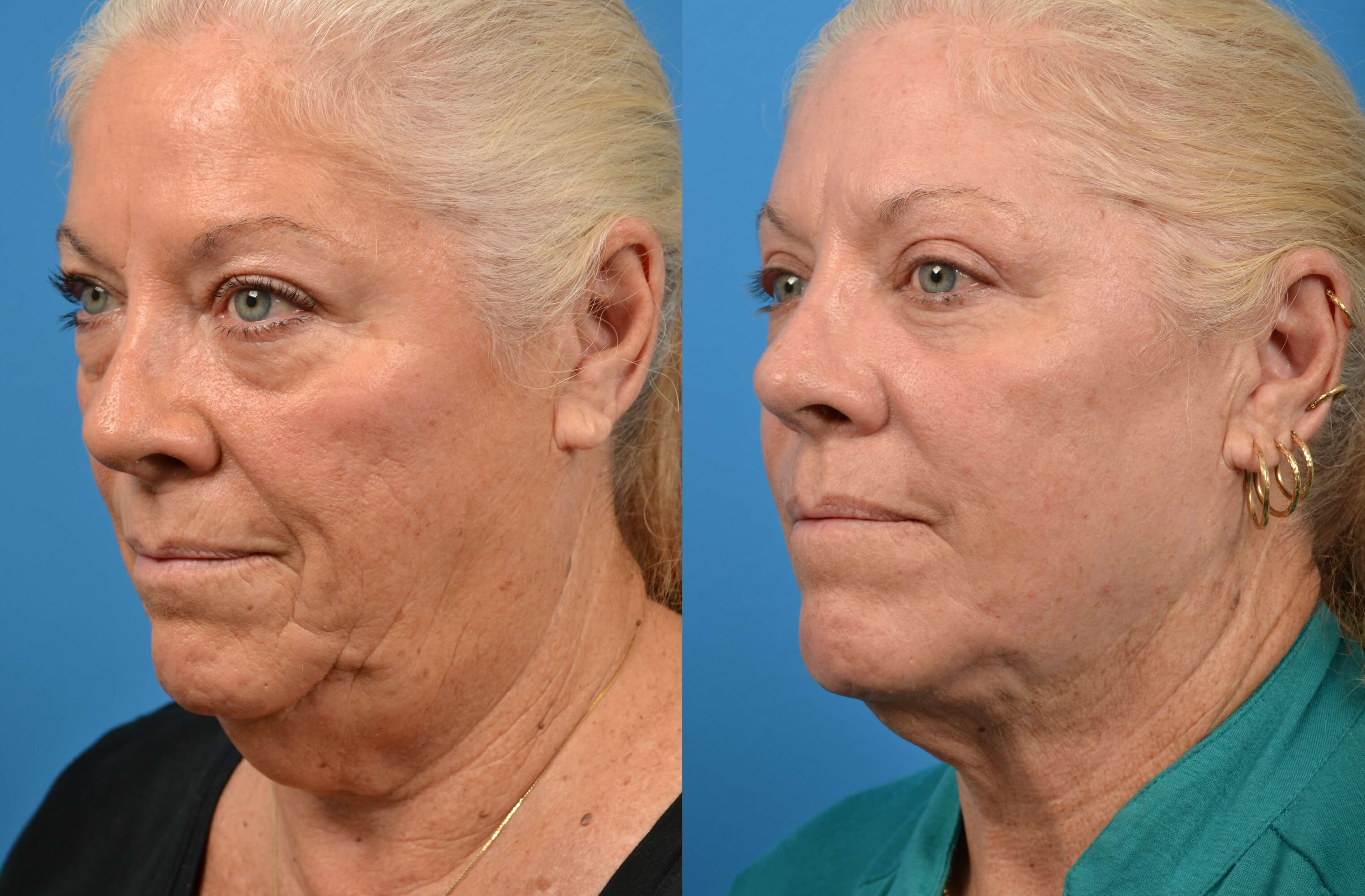 Laser Assisted Weekend Neck Lift Before & After Gallery - Patient 122406477 - Image 3