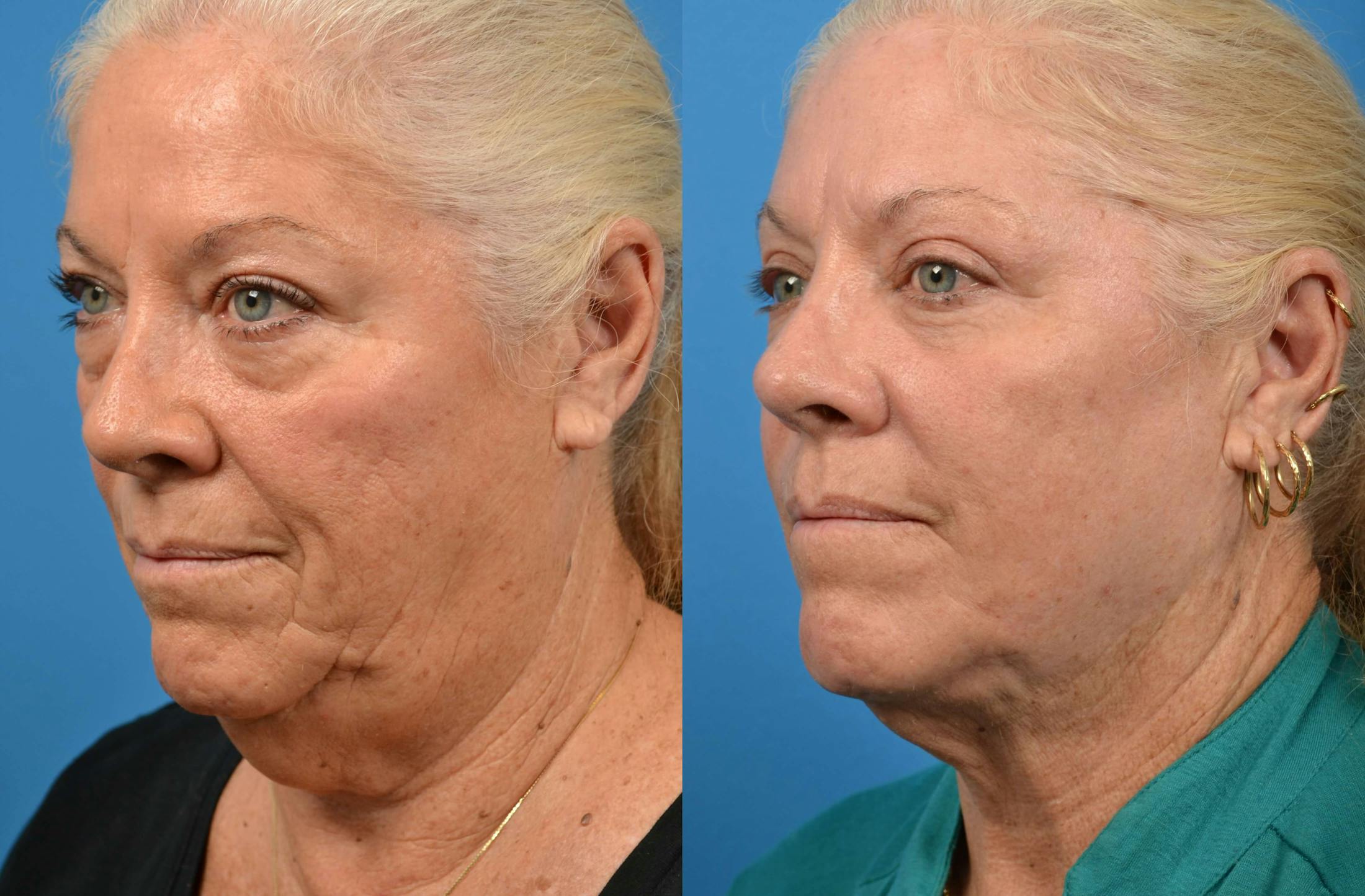 Laser Assisted Weekend Neck Lift Gallery - Patient 122406477 - Image 3
