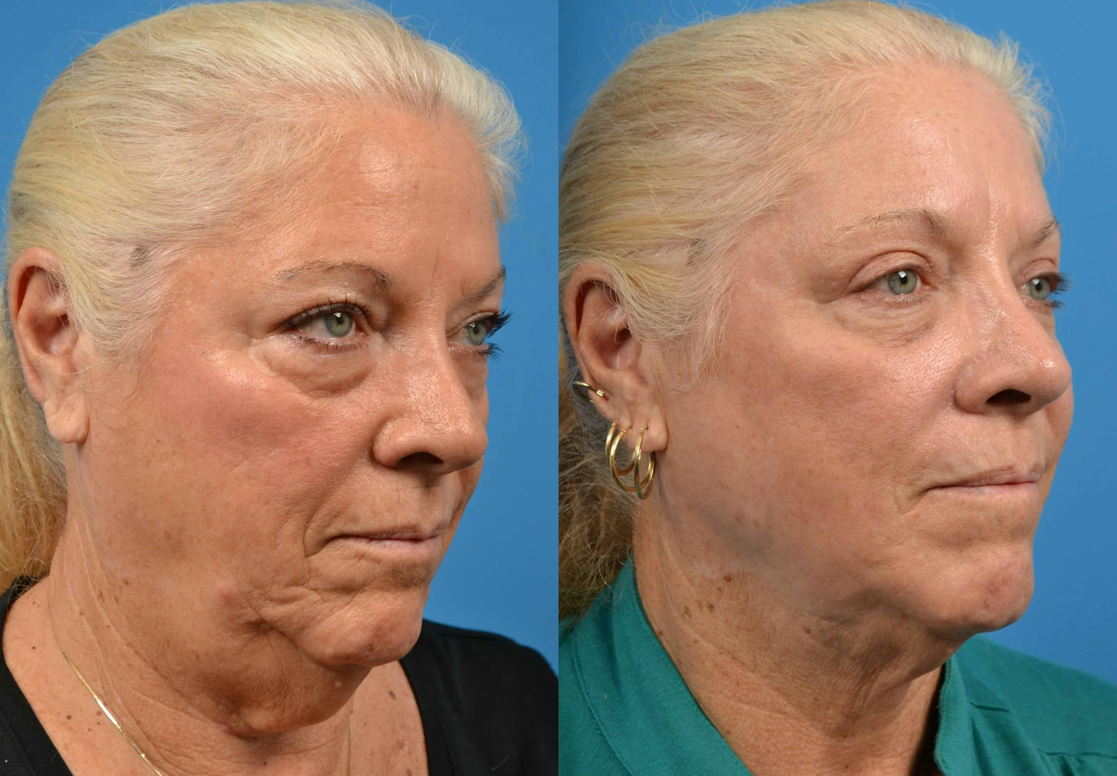 Laser Assisted Weekend Neck Lift Before & After Gallery - Patient 122406477 - Image 4