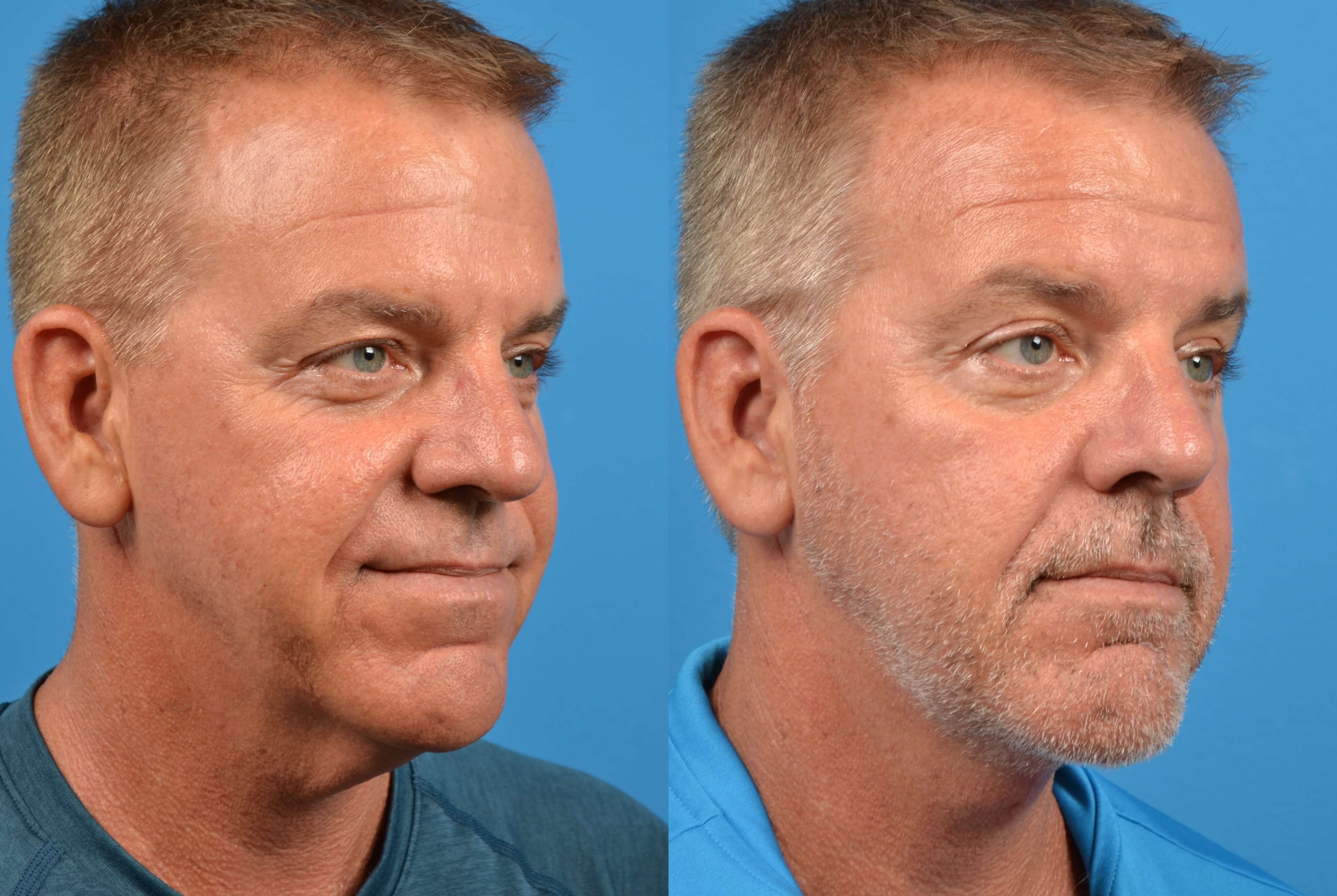 Patient 122406479 Profile Neck Lift Before & After Photos Clevens