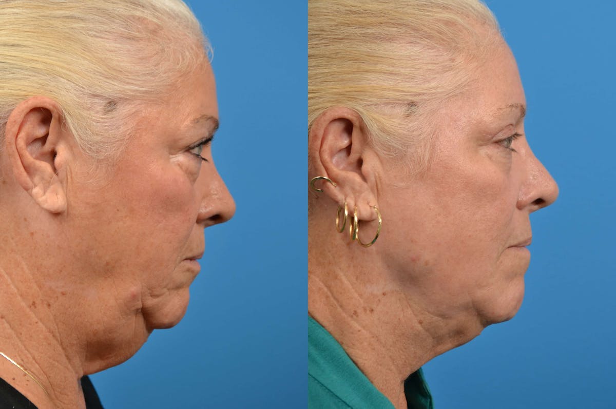 Laser Assisted Weekend Neck Lift Before & After Gallery - Patient 122406477 - Image 5