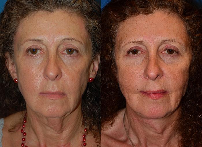 Laser Assisted Weekend Neck Lift Before & After Gallery - Patient 122406481 - Image 1