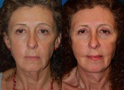 Laser Assisted Weekend Neck Lift Before & After Gallery - Patient 122406481 - Image 1