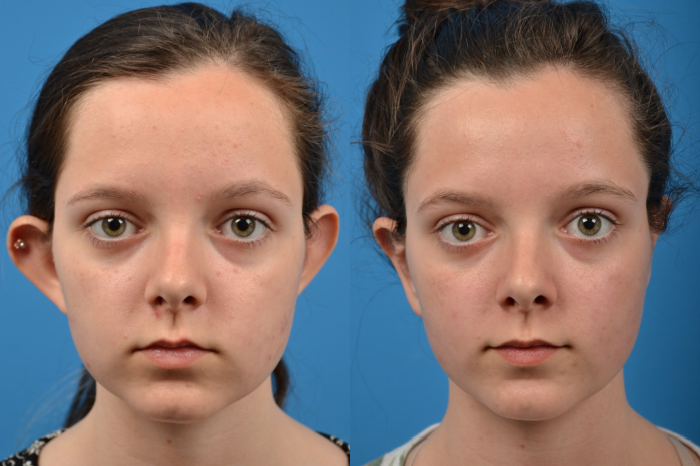 Ear Surgery Before & After Gallery - Patient 122406480 - Image 1