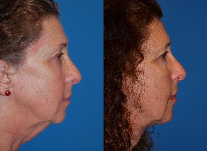Laser Assisted Weekend Neck Lift Before & After Gallery - Patient 122406481 - Image 2