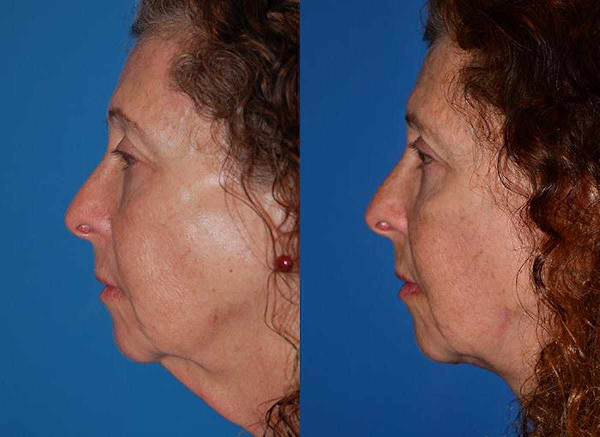 Laser Assisted Weekend Neck Lift Before & After Gallery - Patient 122406481 - Image 3