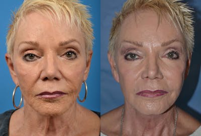 Profile Neck Lift Before & After Gallery - Patient 122406487 - Image 1