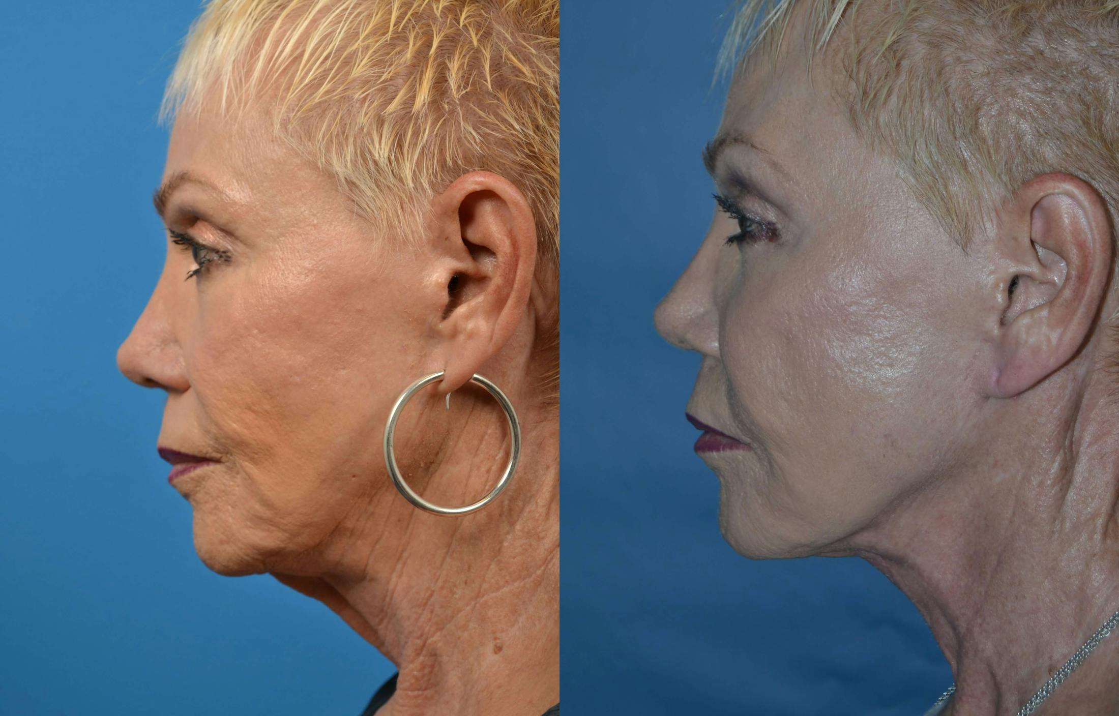 Profile Neck Lift Before & After Gallery - Patient 122406487 - Image 2