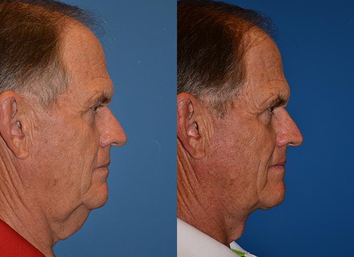 Laser Assisted Weekend Neck Lift Gallery - Patient 122406484 - Image 2