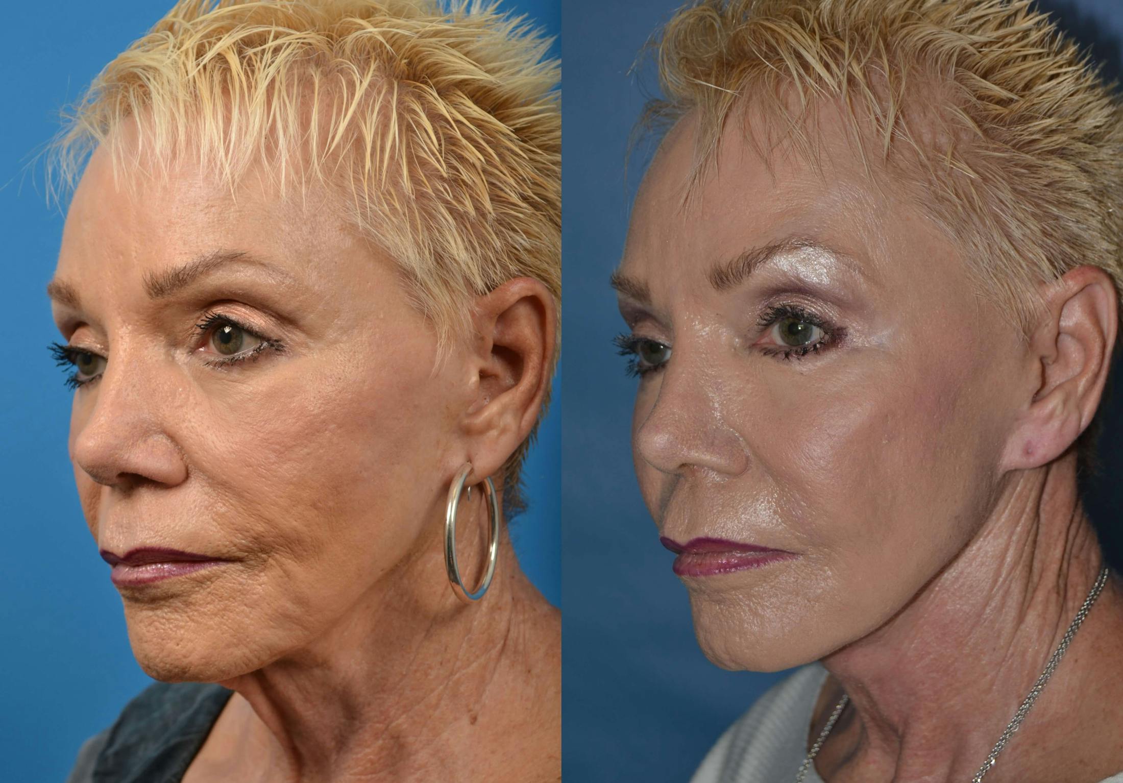 Profile Neck Lift Before & After Gallery - Patient 122406487 - Image 3