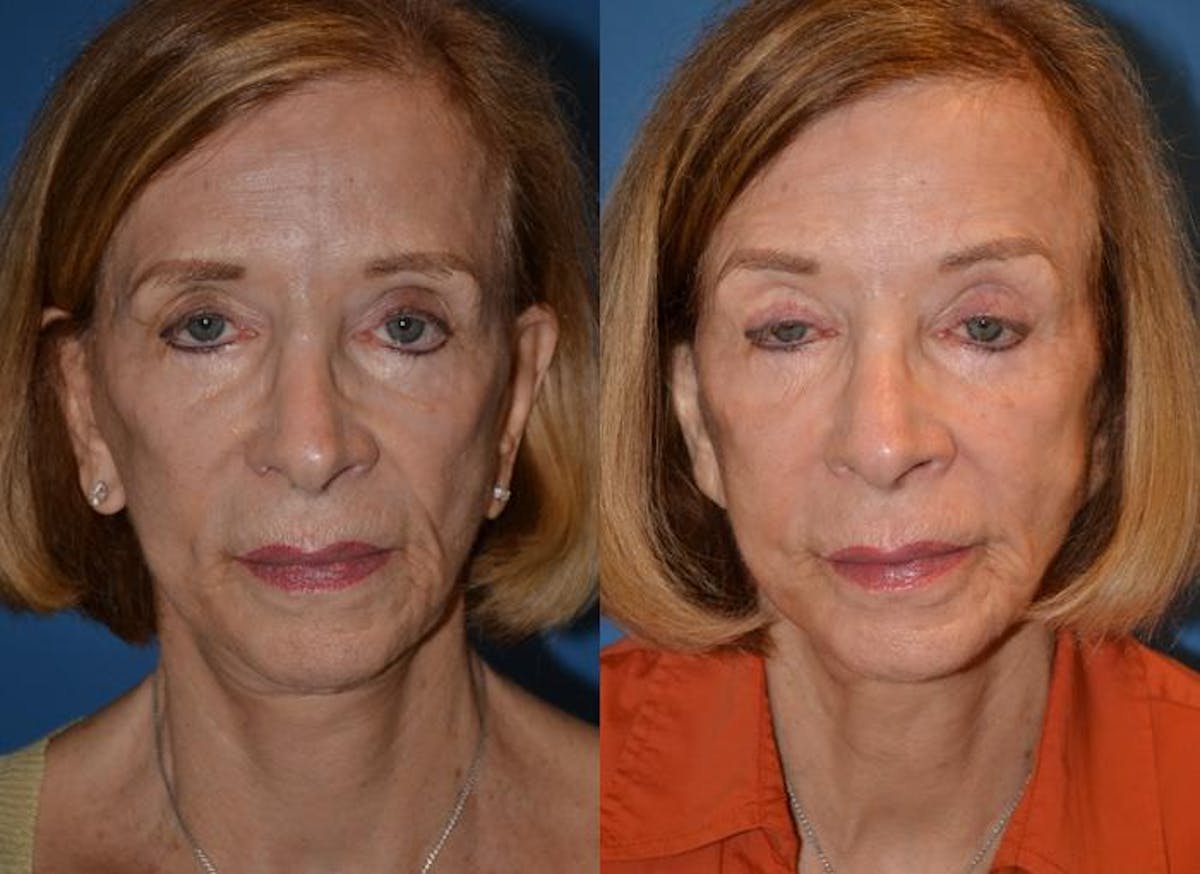 Laser Assisted Weekend Neck Lift Before & After Gallery - Patient 122406485 - Image 1