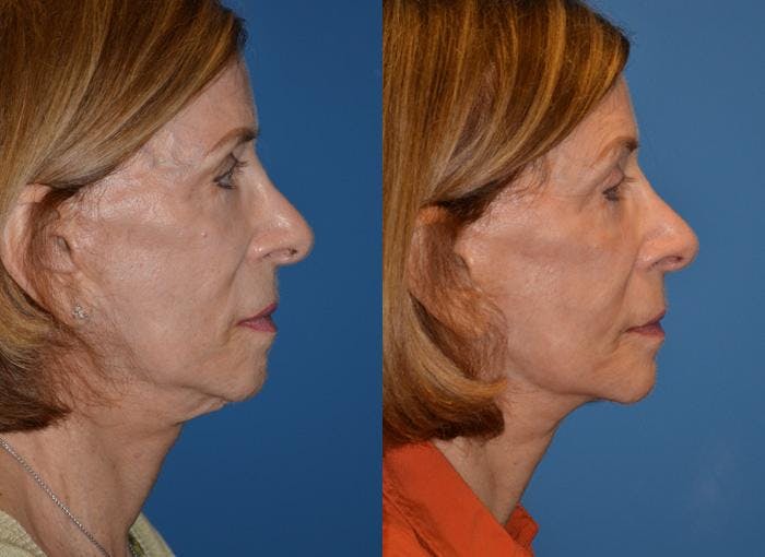 Laser Assisted Weekend Neck Lift Before & After Gallery - Patient 122406485 - Image 2