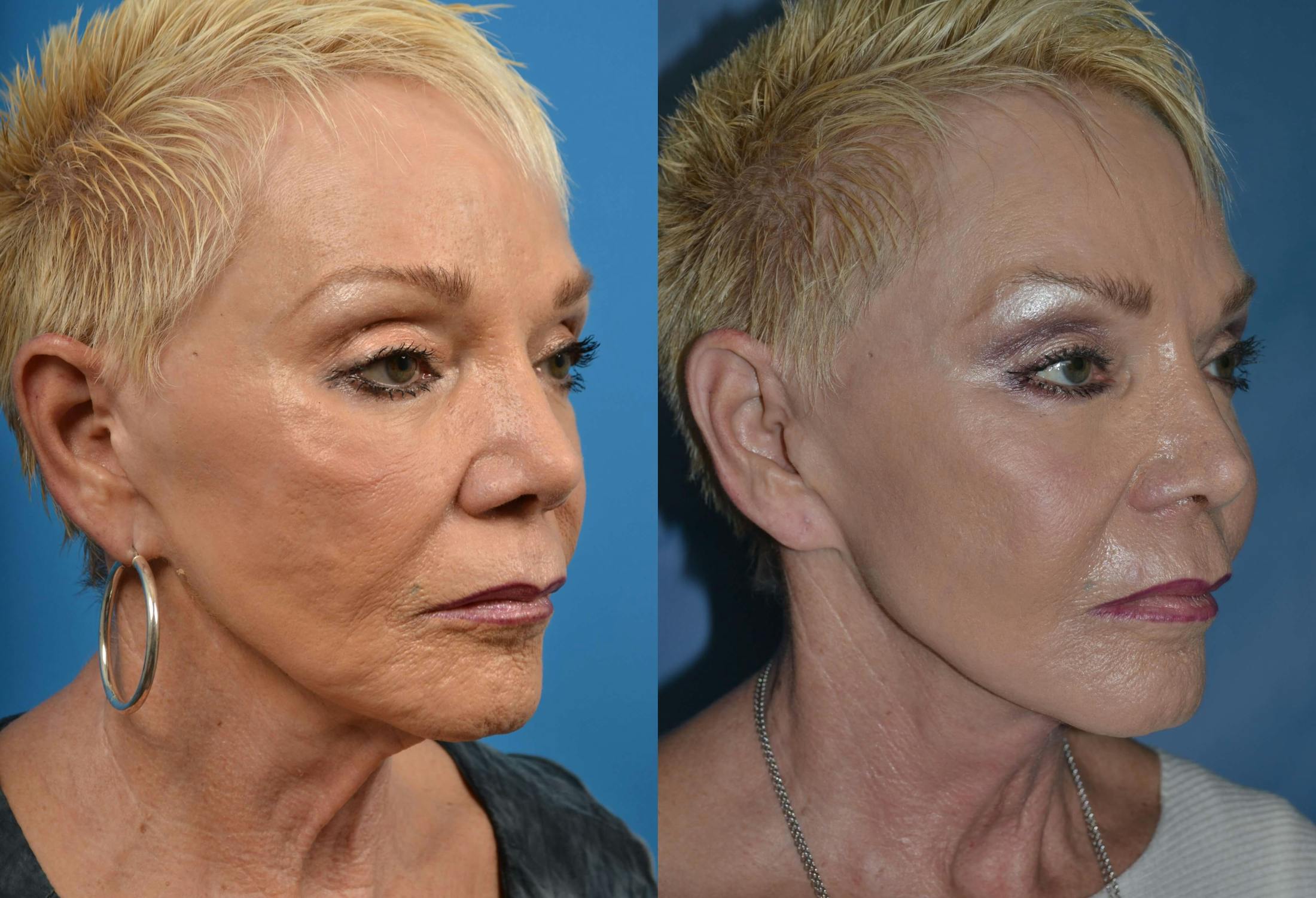 Profile Neck Lift Before & After Gallery - Patient 122406487 - Image 4