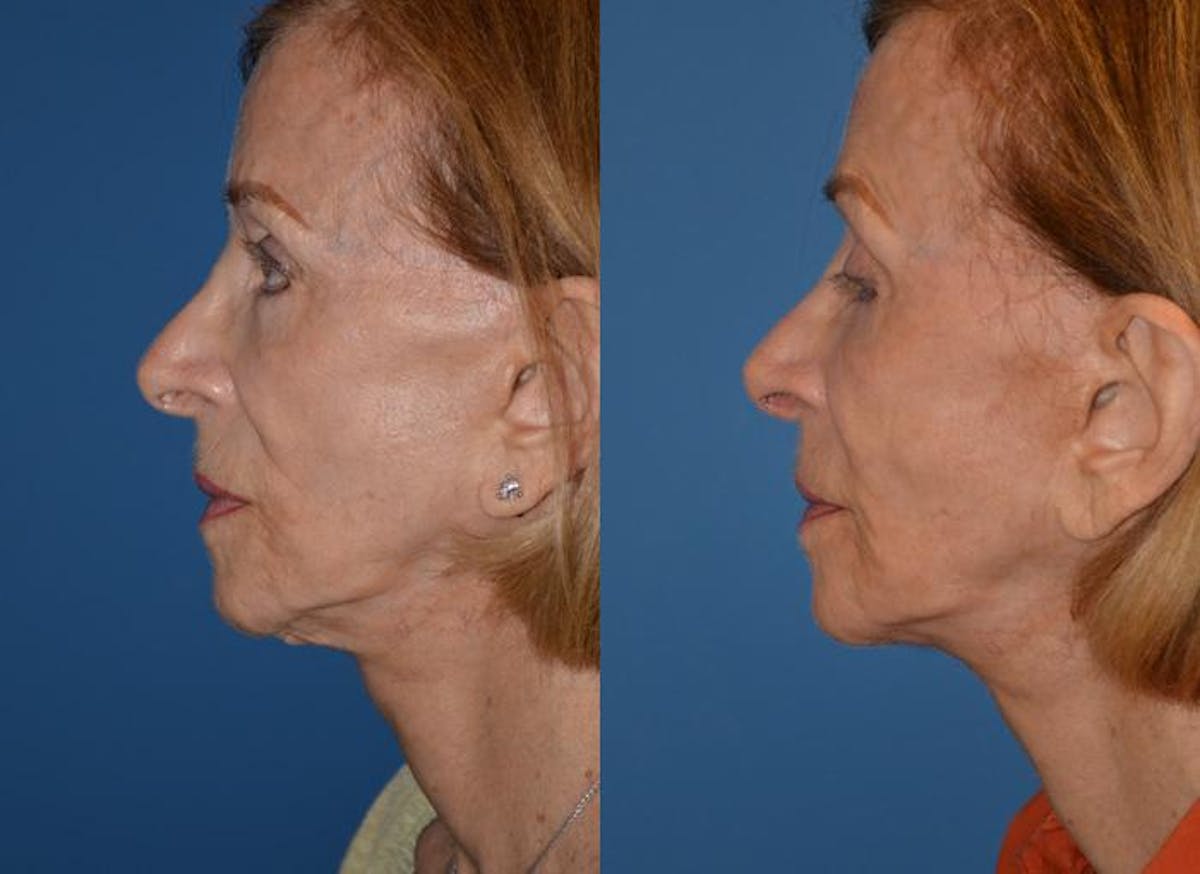 Laser Assisted Weekend Neck Lift Before & After Gallery - Patient 122406485 - Image 3
