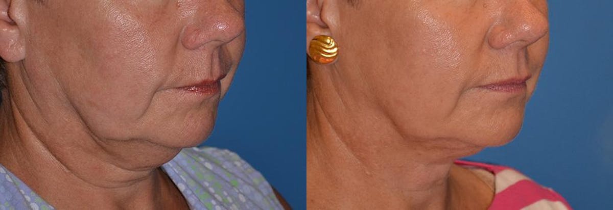 Laser Assisted Weekend Neck Lift Before & After Gallery - Patient 122406486 - Image 1