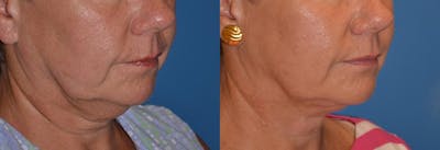 Laser Assisted Weekend Neck Lift Before & After Gallery - Patient 122406486 - Image 1
