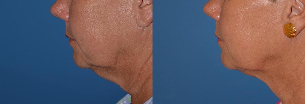 Laser Assisted Weekend Neck Lift Before & After Gallery - Patient 122406486 - Image 2