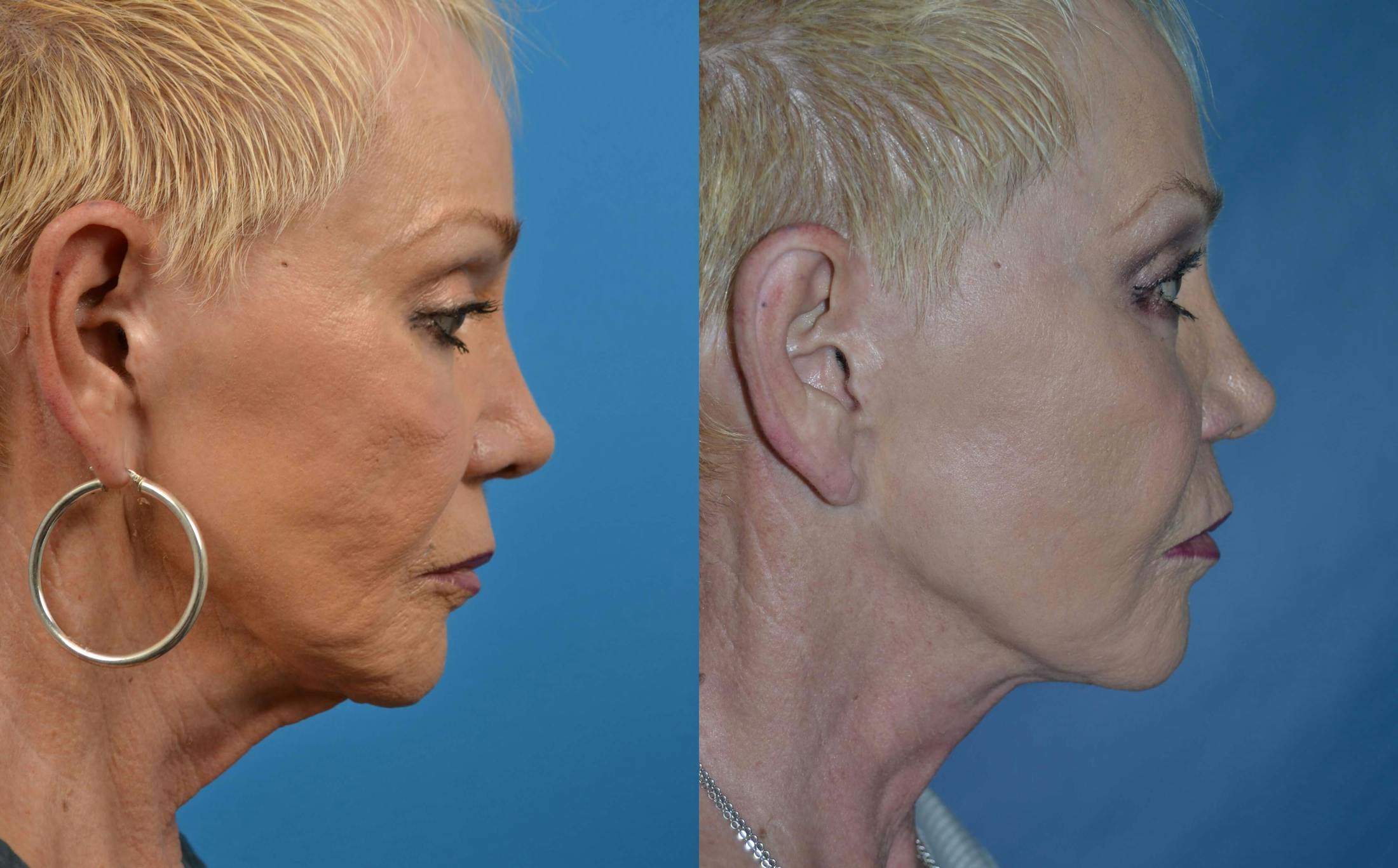 Profile Neck Lift Before & After Gallery - Patient 122406487 - Image 5