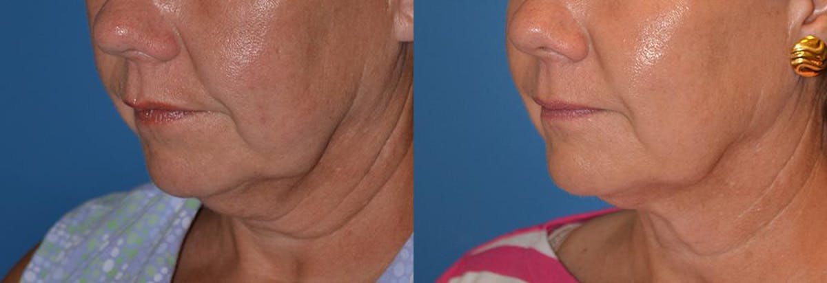 Laser Assisted Weekend Neck Lift Before & After Gallery - Patient 122406486 - Image 3