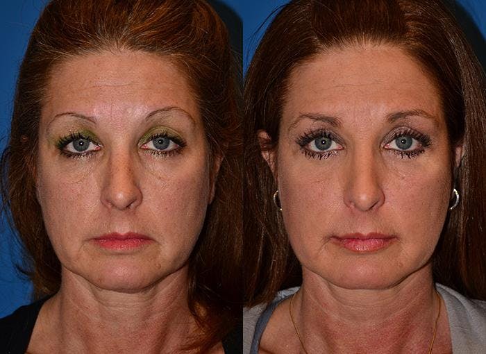 Laser Assisted Weekend Neck Lift Before & After Gallery - Patient 122406489 - Image 1
