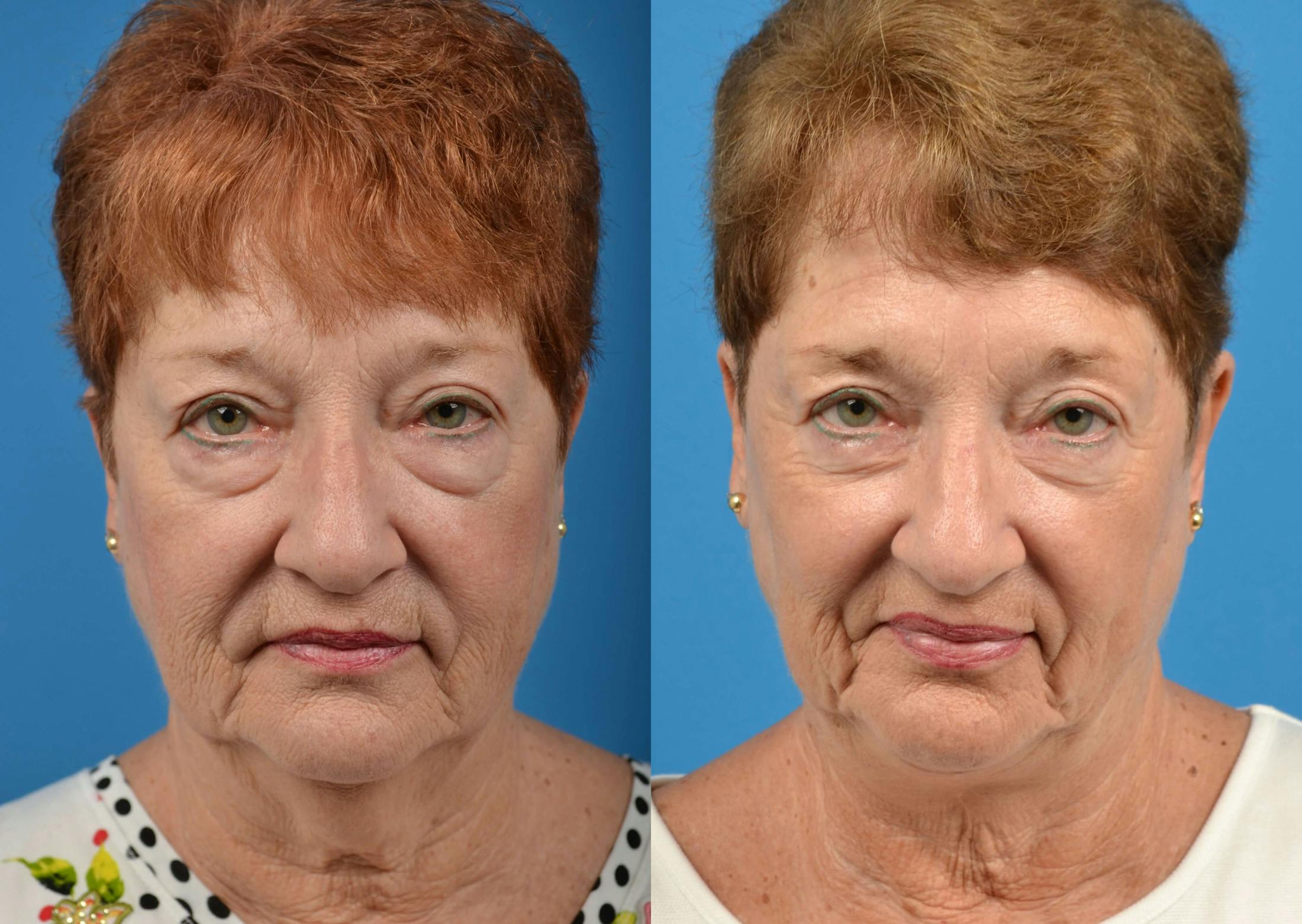 Profile Neck Lift Before & After Gallery - Patient 122406494 - Image 1