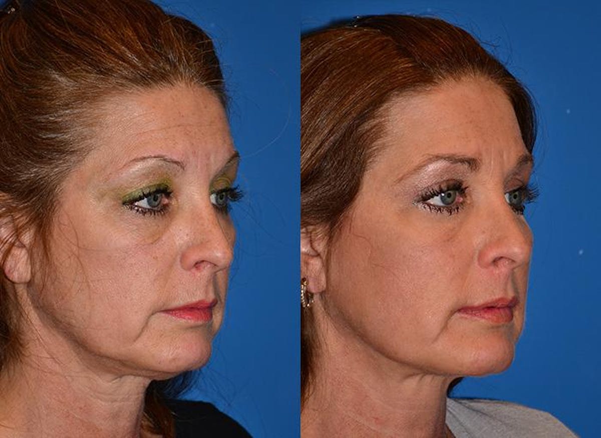 Laser Assisted Weekend Neck Lift Before & After Gallery - Patient 122406489 - Image 2