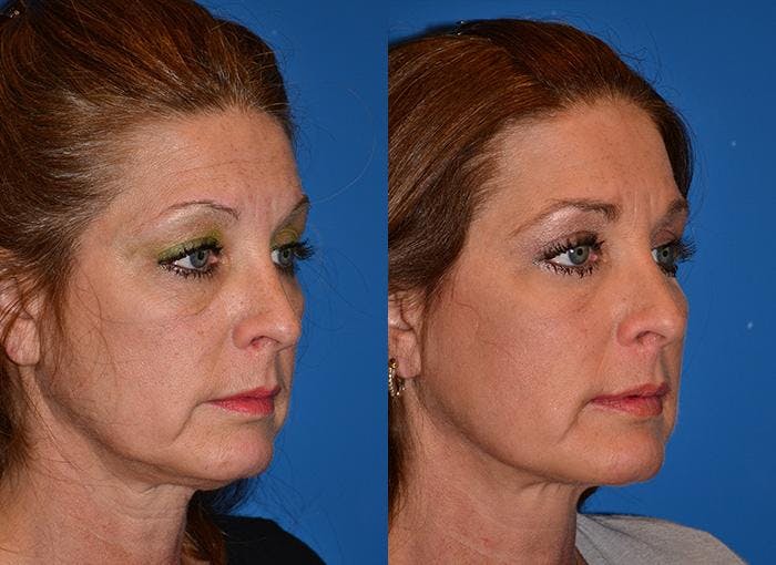 Laser Assisted Weekend Neck Lift Before & After Gallery - Patient 122406489 - Image 2