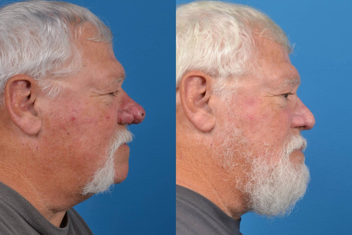 Rhinophyma Before & After Gallery - Patient 122406496 - Image 1