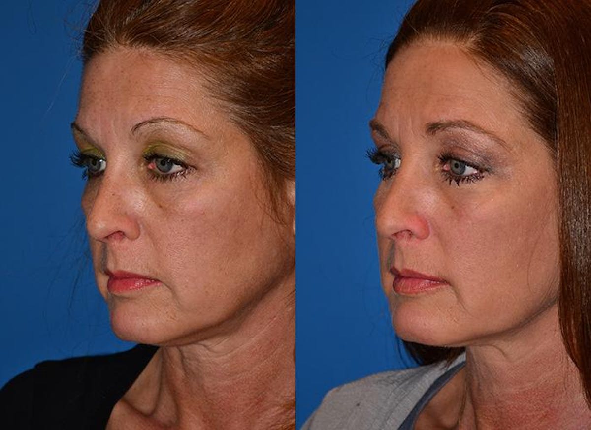 Laser Assisted Weekend Neck Lift Before & After Gallery - Patient 122406489 - Image 3
