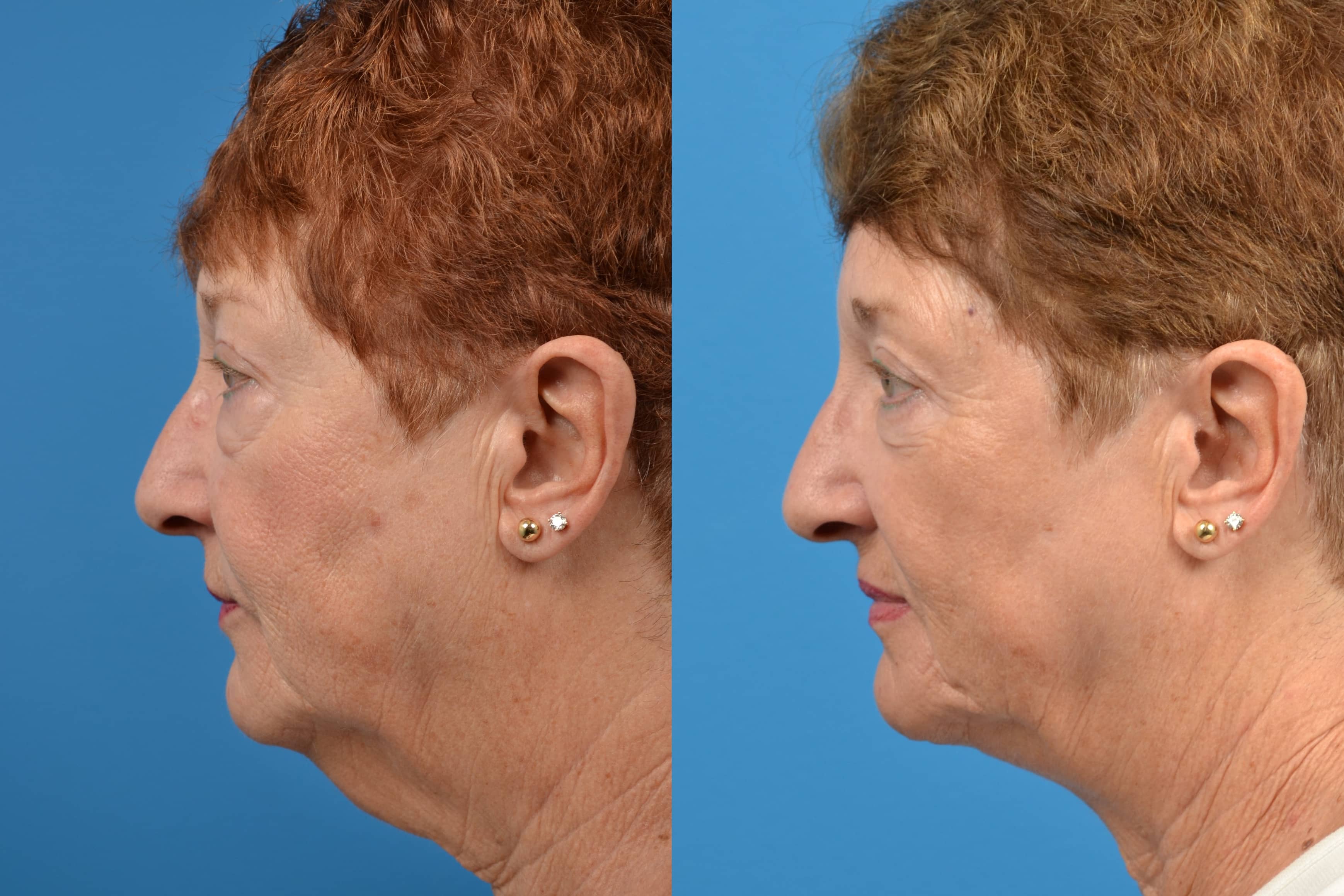 Profile Neck Lift Before & After Gallery - Patient 122406494 - Image 2