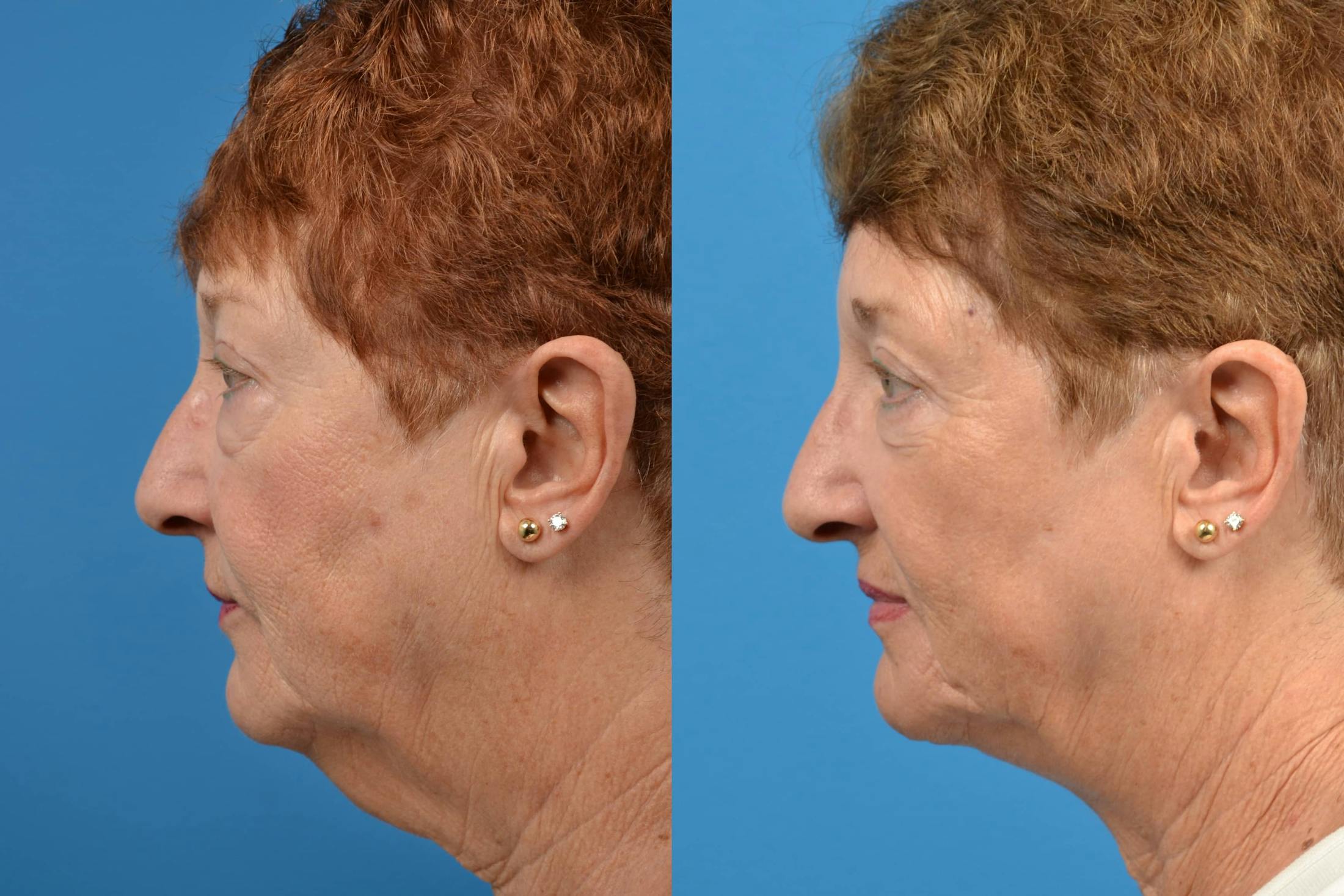 Profile Neck Lift Before & After Gallery - Patient 122406494 - Image 2